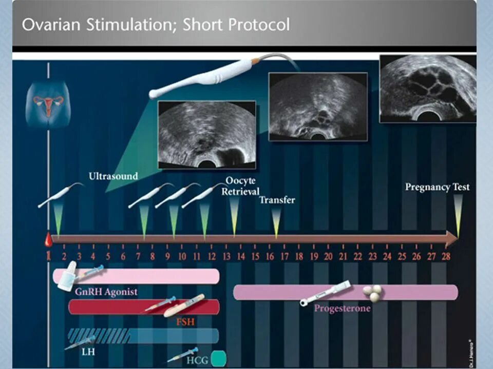 Стимуляция овуляции для зачатия естественным. Стимуляция овуляции короткий протокол эко. Стимуляция овуляции протокол схема. Короткий протокол стимуляции эко схема. Стимуляция суперовуляции схема.
