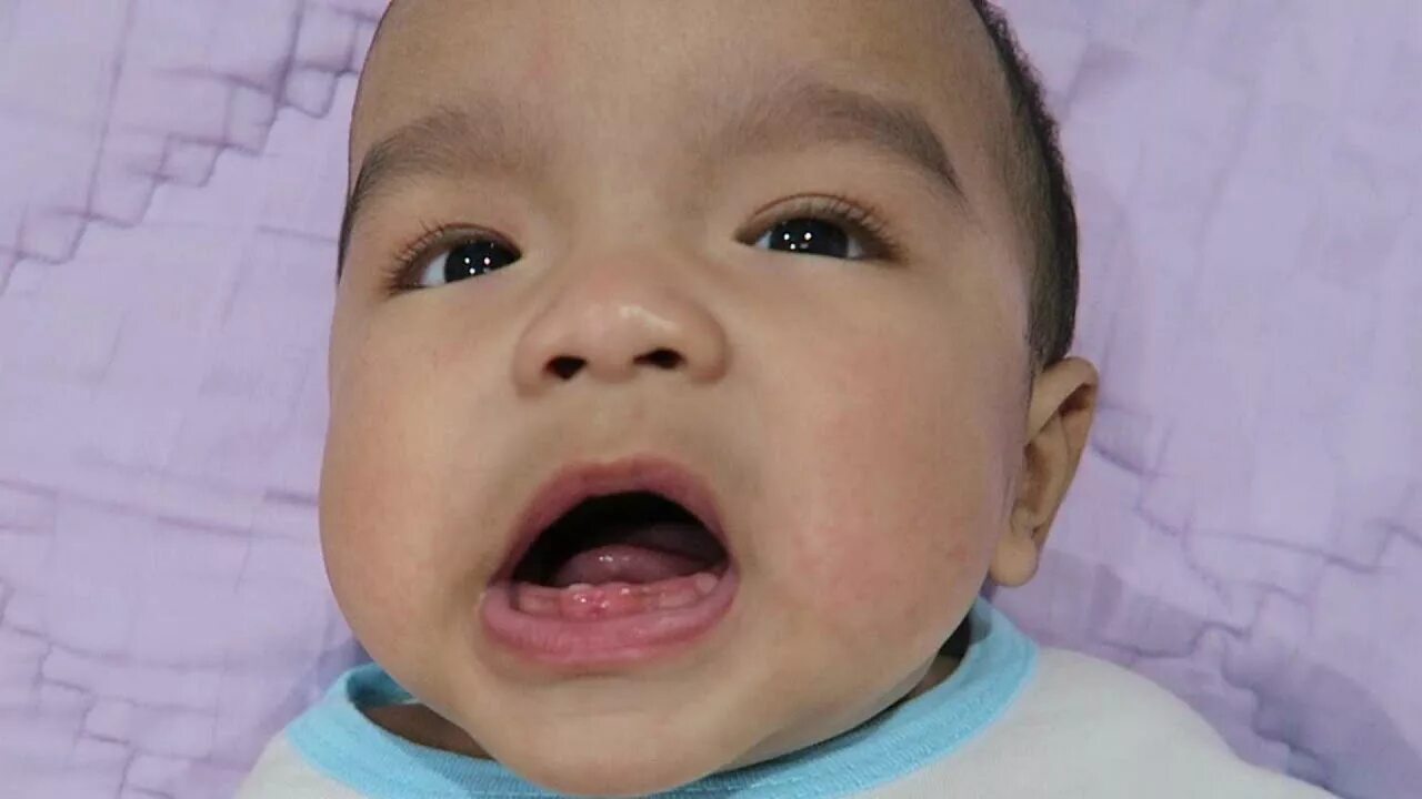 Lip Tie in Babies: What Parents Need to Know