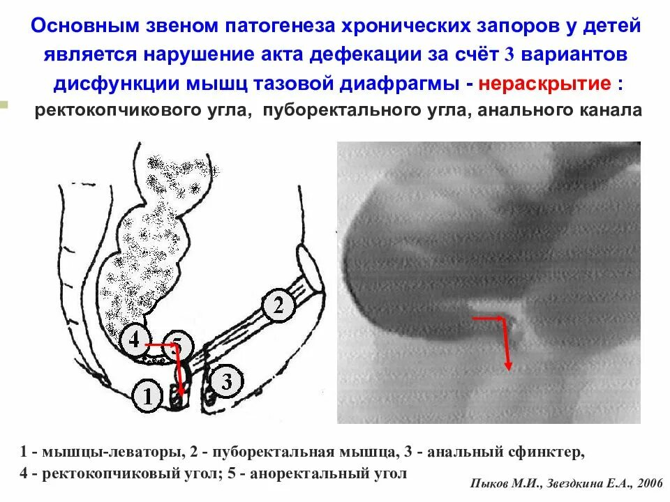 Дефекация 1. Механизм развития запора. Патогенез запора. Патогенез хронического запора.