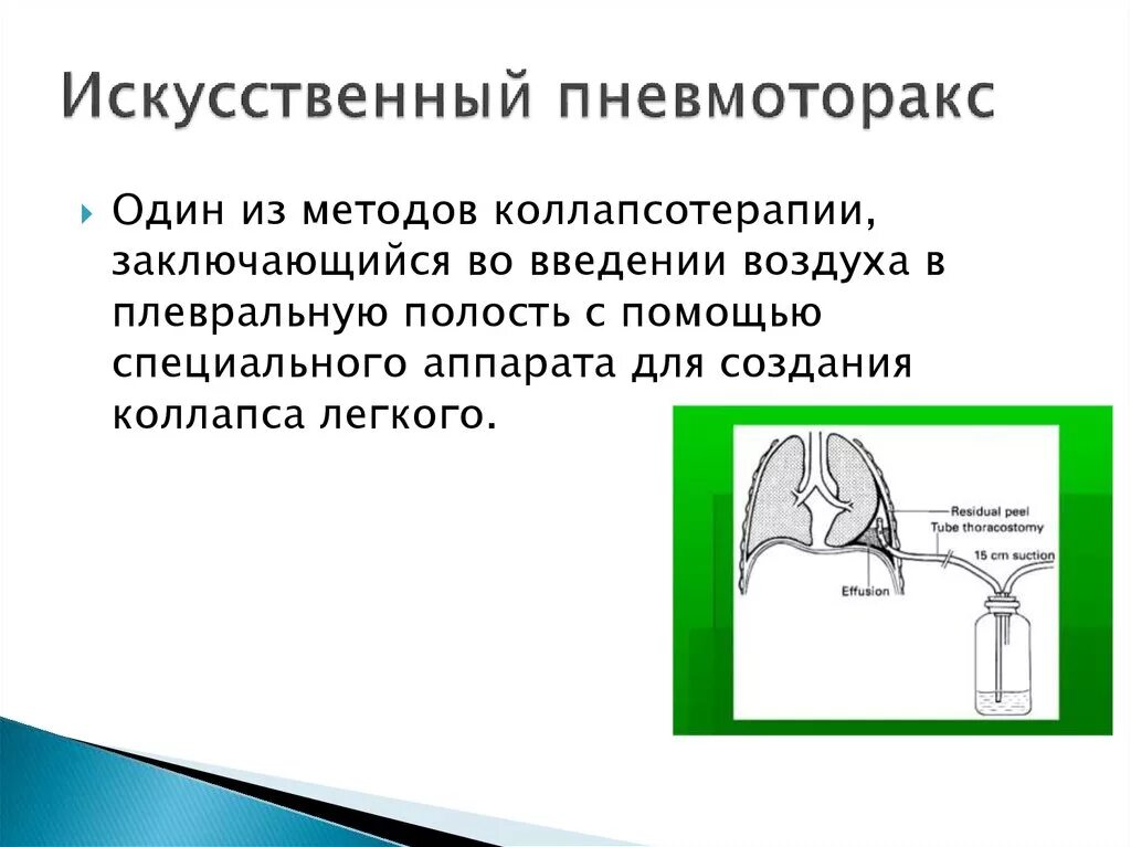 Искусственный пневмоторакс