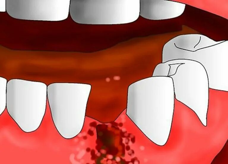 Почему кровь из зубов. Постэкстракционный альвеолит. Альвеолит зубной лунки. Альвеолит воспаление лунки.