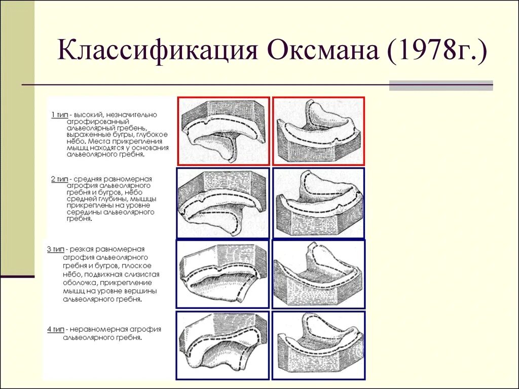 Люнд слизистой оболочки. Классификация беззубых челюстей по и.м. Оксману. Классификация слизистой по Оксману. Классификации беззубых челюстей (Шредера, Келлера, Оксмана).. Классификация атрофии альвеолярного отростка нижней челюсти.