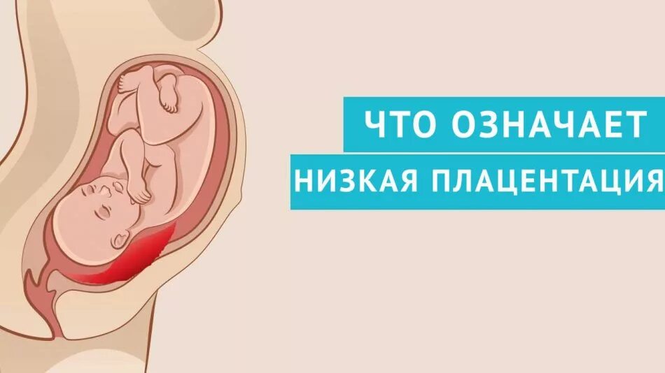 Что значит будучи беременной. Низкая плацентация при беременности. низкая плацента у беременной. что такое низкая плацентация у беременных. плацента на 20 неделе беременности.