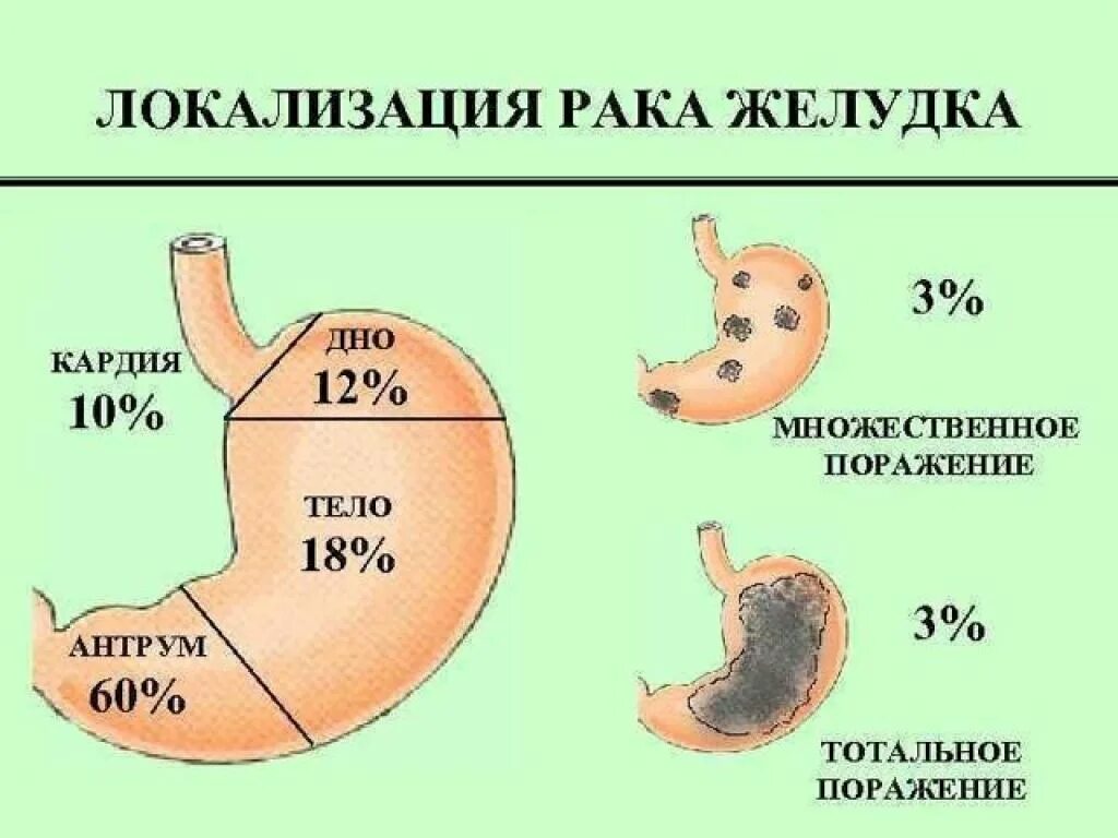 Локализация опухоли желудка. Наиболее частая локализация карциномы желудка. Локализация карциномы желудка. Частая докализация оакажелудка. Размеры язвы желудка