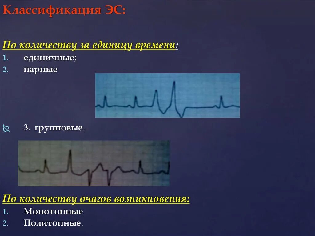 Политопная желудочковая экстрасистолия на ЭКГ. Монотопные экстрасистолы. Монотопная желудочковая экстрасистолия. Полиморфная экстрасистолия. Политопные экстрасистолы