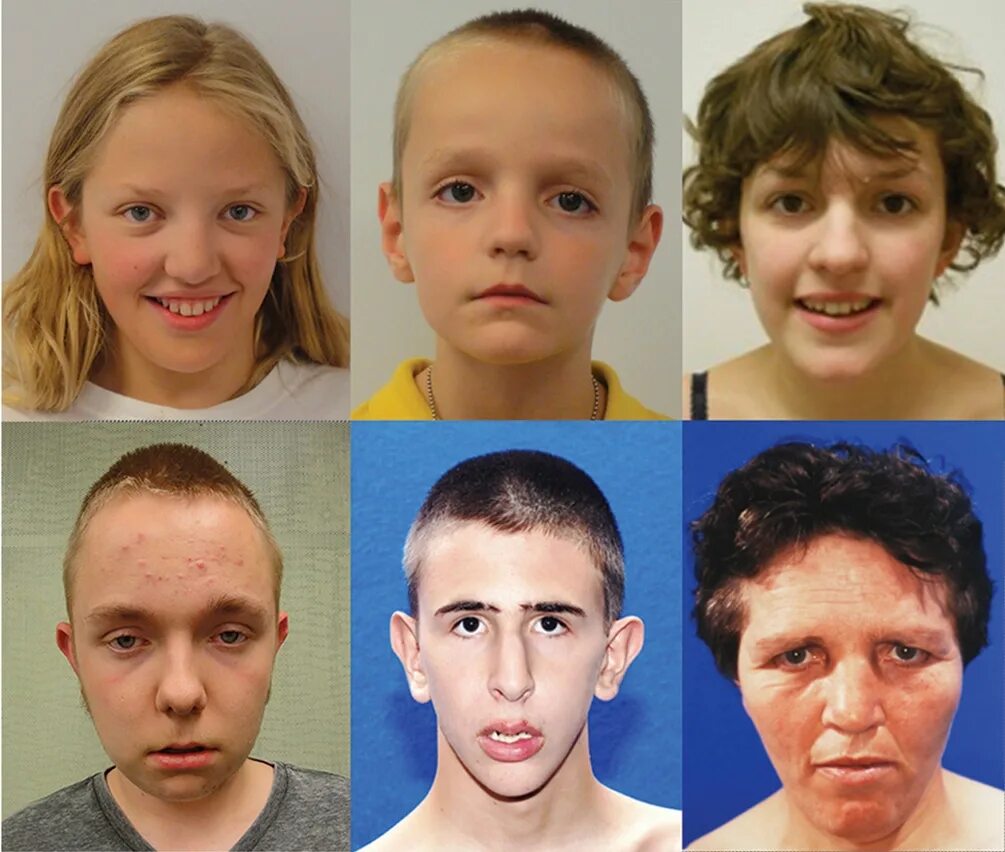 Патология у подростков. Люди с особенностями внешности. Люди с генетическими отклонениями.