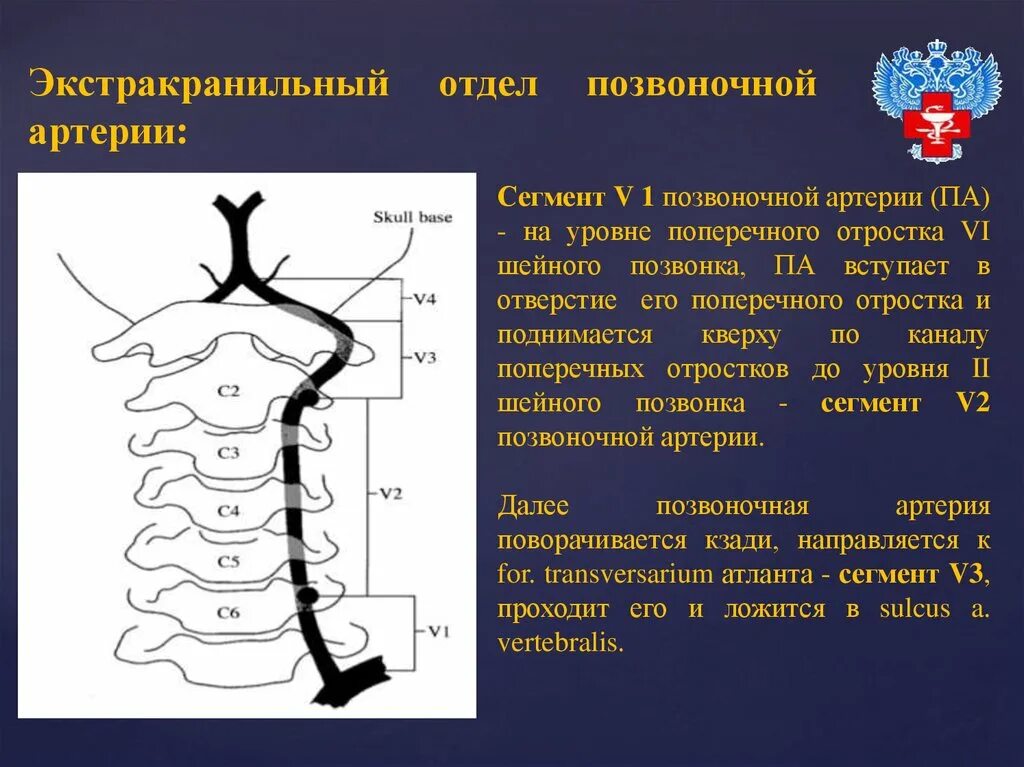 Сегменты v1 v2 позвоночных артерий. Позвоночная артерия с3 с4 сегмент. Сегмент v2 позвоночной артерии. Ход позвоночных артерий сегменты v2.