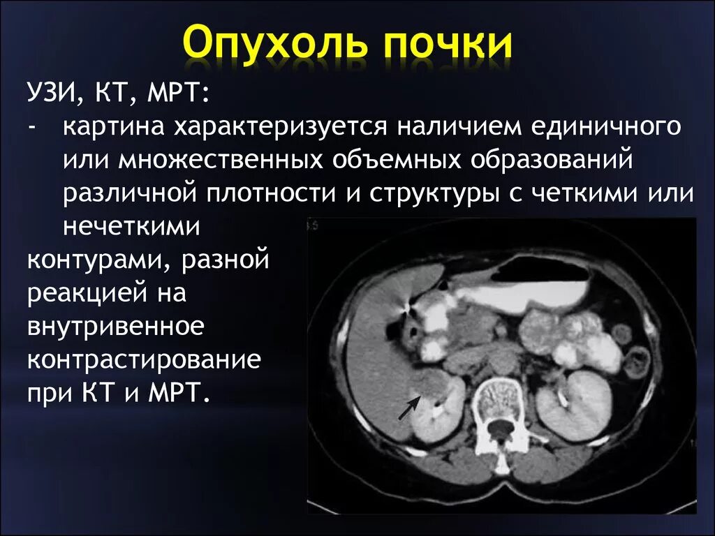 Рак почки причины. Метод диагностики опухоли почек. Опухоль почки кт симптомы. Объемные образования почек кт.