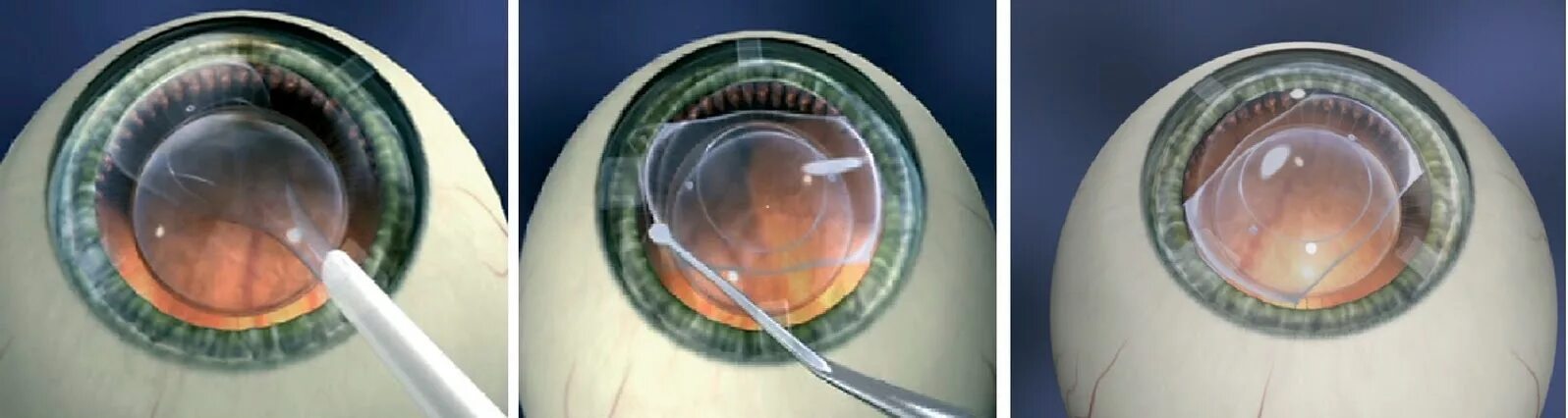 Имплантация факичных интраокулярных линз. Факичные интраокулярные линзы (ИОЛ).. После операции на катаракту рекомендации
