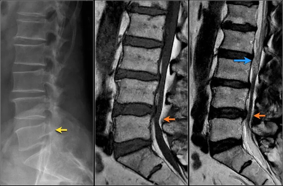 Дегенеративный спинальный стеноз l3-l4. Спинальный стеноз с6-с7. Спинальный стеноз поясничного отдела позвоночника. Крестцовый стеноз