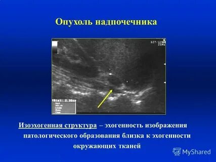 Эхогенность образований на узи