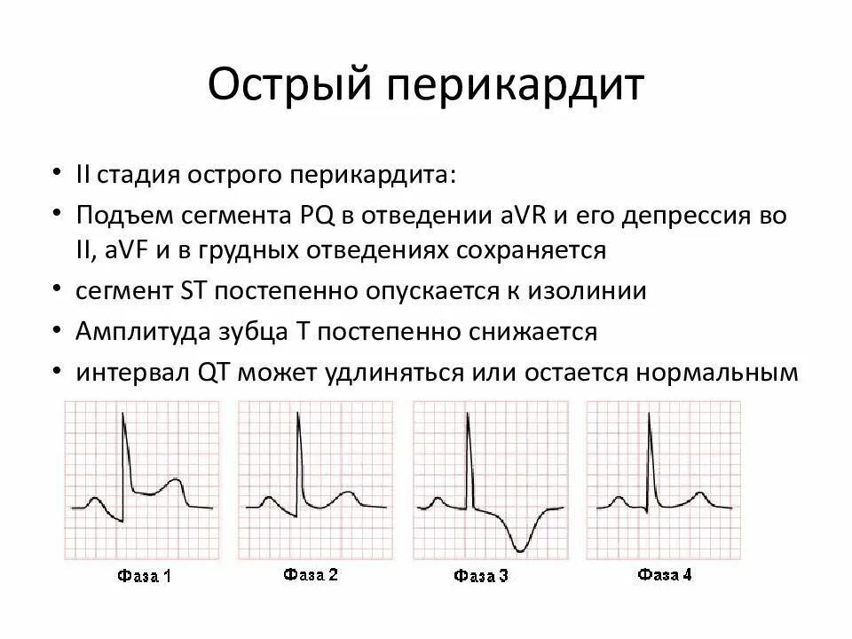 Экг подъем. Подъем сегмента St на ЭКГ v3. Инфаркт миокарда без подъема сегмента St ЭКГ. Подъем сегмента St на ЭКГ v1 v2. Подъем сегмента St в v2-v3.