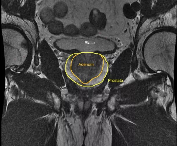 Зональная анатомия предстательной железы. Зональная анатомия предстательной железы мрт. Аденома предстательной железы мрт. Аденома простаты мрт