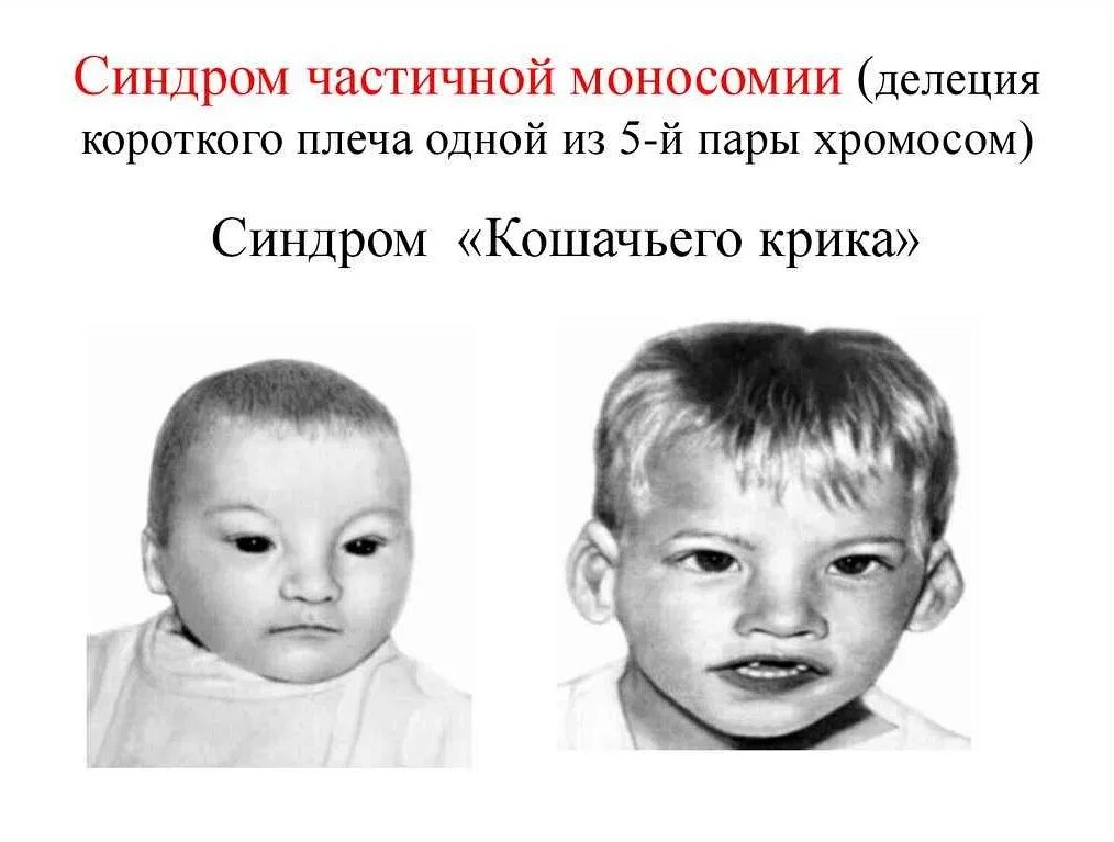 Синдром трисомии 9 хромосомы. Частичный синдром. Частичный синдром. Гетероплоидия анеуплоидия. Синдром кошачьего крика (делеция в 5-ой хромосоме);.