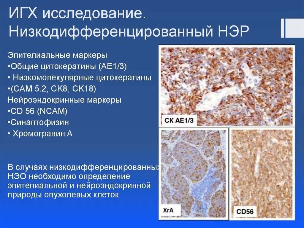 Иммуногистохимия метод гистология. СД 45 ИГХ. CD 34 маркер ИГХ. Иммуногистохимия опухоли молочной железы. Иммуногистохимические маркеры