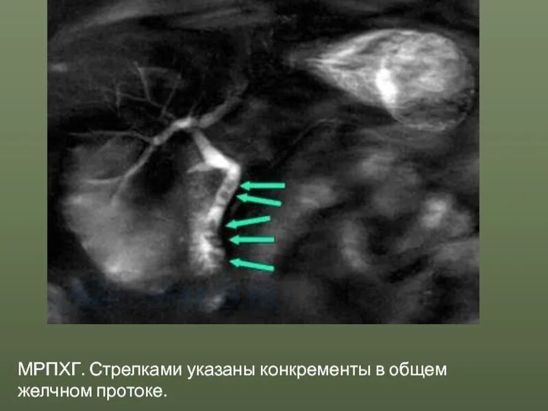 Желчекаменная болезнь ЭРХПГ. Магнитно-резонансная панкреатохолангиография желчного пузыря. Конкременты желчного пузыря рентген. Магнитно-резонансная холангиопанкреатография при ЖКБ.