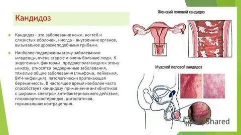 Клиническая молочница
