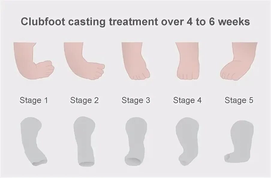 Эмблема фут клуб жалгерис. Club foot перевод. Эквиноварусная косолапость. Club foot перевод. Эквиноварусная косолапость.
