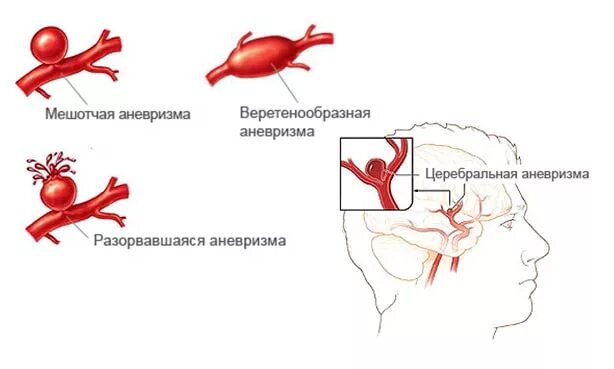 Веретеновидная аневризма. Классификация аневризм сосудов головного мозга. Аневризма мозговой артерии. Артериальные и артериовенозные аневризмы сосудов головного мозга.