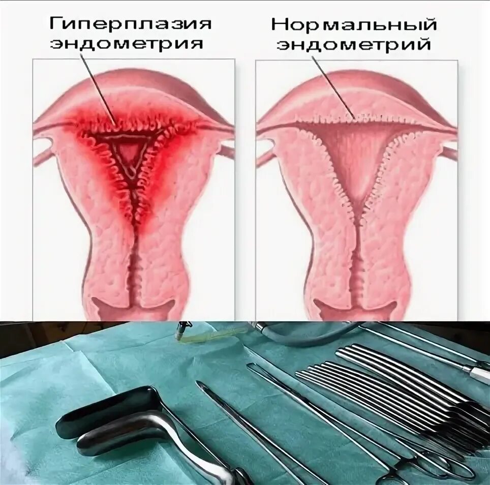 Что такое эндометрия матки. Что такое эндометрия матки