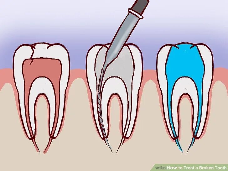 Распломбировка каналов зуба