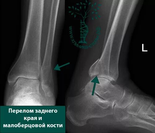 Трещина заднего зажила. Косой перелом дистального метаэпифиза малоберцовой кости. Перелом малой берцовой кости. Перелом дистального метадиафиза малоберцовой кости. Дистальный метаэпифиз малоберцовой кости перелом лодыжки.