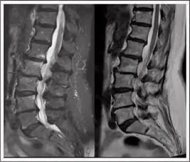 Мр картина дистрофических изменений поясничного отдела позвоночника. Дегенеративные-дистрофических изменений l1-s1. Искривление позвоночника на мрт. Дегенеративные изменения позвоночника мрт. Дегенеративно-дистрофические изменения l2 l3.