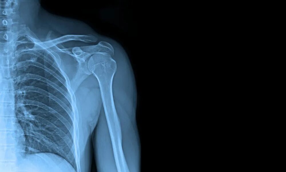 Shoulder XRAY. X-ray картина. Рентген снимки стоковое фото. Рентген фото для презентации.