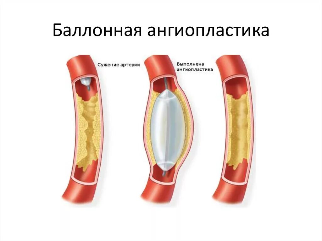 Баллонная ангиопластика коронарных артерий. Баллонная ангиопластика и стентирование. ТРАНСЛЮМИНАЛЬНАЯ баллонная ангиопластика коронарных артерий. Баллонная ангиопластика сосудов нижних конечностей.