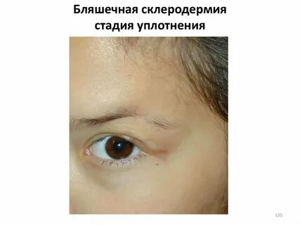 Что такое склеродермия простыми словами