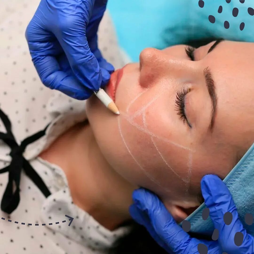 Radiesse контурная пластика. филлеры в среднюю треть лица. Radiesse контурная пластика. контурная пластика препаратом radiesse. Radiesse биоревитализация.