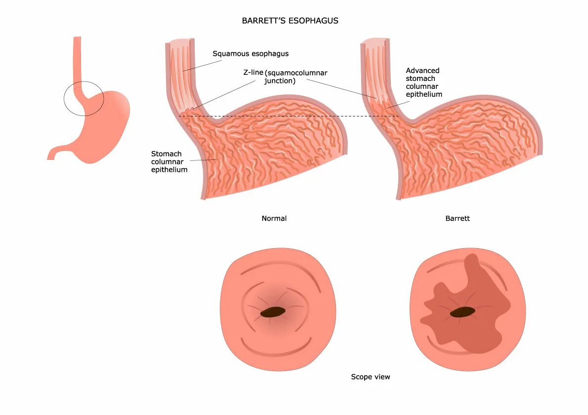 Классификация пищевода Барретта эндоскопия. Пищевод Барретта эндоскопия.