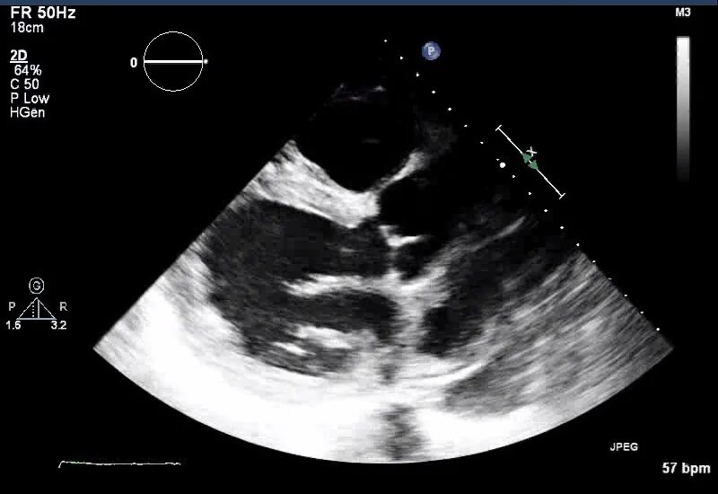 Трансторакальная комплексная эхокардиография. Трансторакальная эхокардиография показания. Трансторакальное узи сердца. Эхокг сердца через пищевод. Трансторакальное узи сердца.