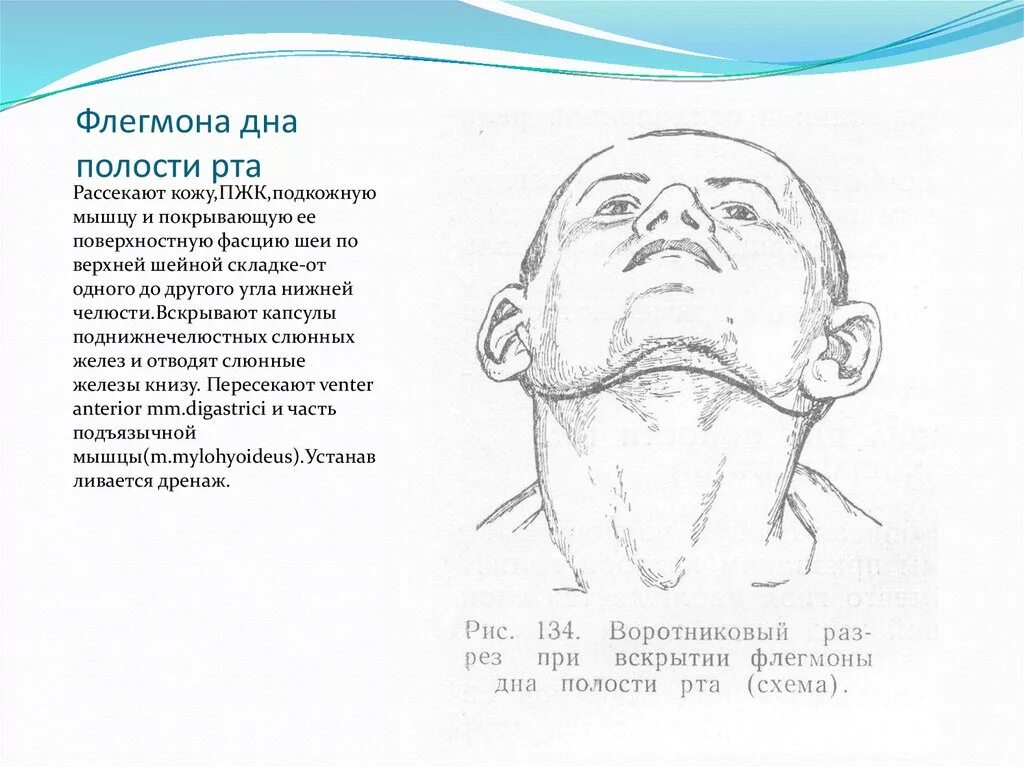 Разрез при флегмоне дна полости рта. Флегмона дна ротовой полости. Флегмоны челюстно-лицевой области и шеи. Вскрытие флегмоны дна полости рта. Операция абсцесс шеи