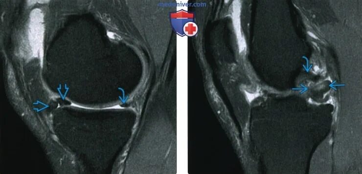 Повреждение медиального мениска коленного сустава мрт. Лоскутный разрыв медиального мениска коленного. Дегенеративные изменения заднего рога медиального мениска 2