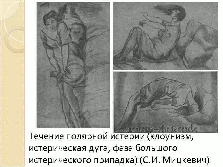 Женская истерия. Истерический припадок. Женская истерия. Женская истерия. Эпилептические картины.