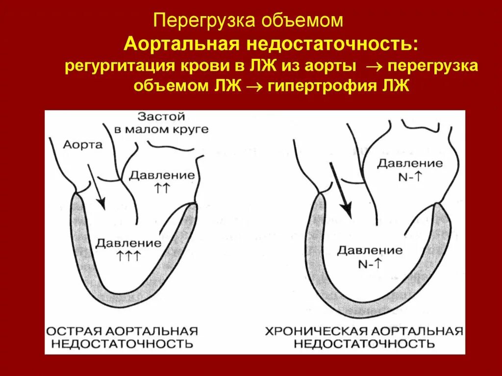 Синдром аорты. Недостаточность аортального клапана гемодинамика. недостаточность клапана аорты гемодинамика. аортальная недостаточность этиология. аортальная недостаточность гемодинамика схема.