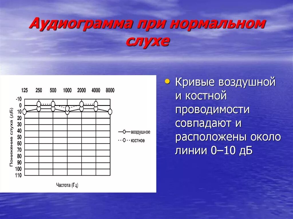 Аудиограмма норма. Аудиограмма слуха норма. Расшифровка аудиометрии слуха норма. Аудиограмма слух -10дб. Тональная пороговая аудиометрия норма.