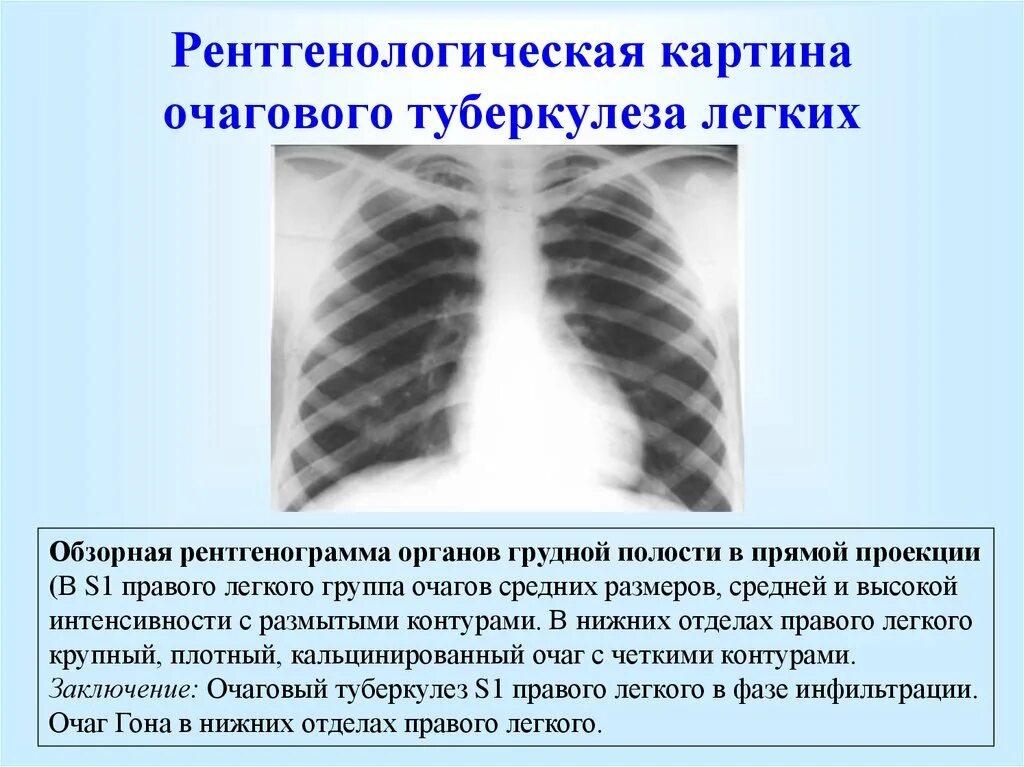 Очаги в нижней доле легкого. Очаговый туберкулез легкого рентген. Инфильтративный туберкулез рентген. Очаговый туберкулез туберкулез кт. Туберкулез легкого на рентгенограмме очаговый.