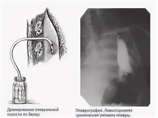 Лечение плевральной полости. Пневмоторакс дренаж по Бюлау. Плевральный дренаж при пневмотораксе. Плевральный дренаж Бюлау. Дренаж по Бюлау при пневмотораксе.