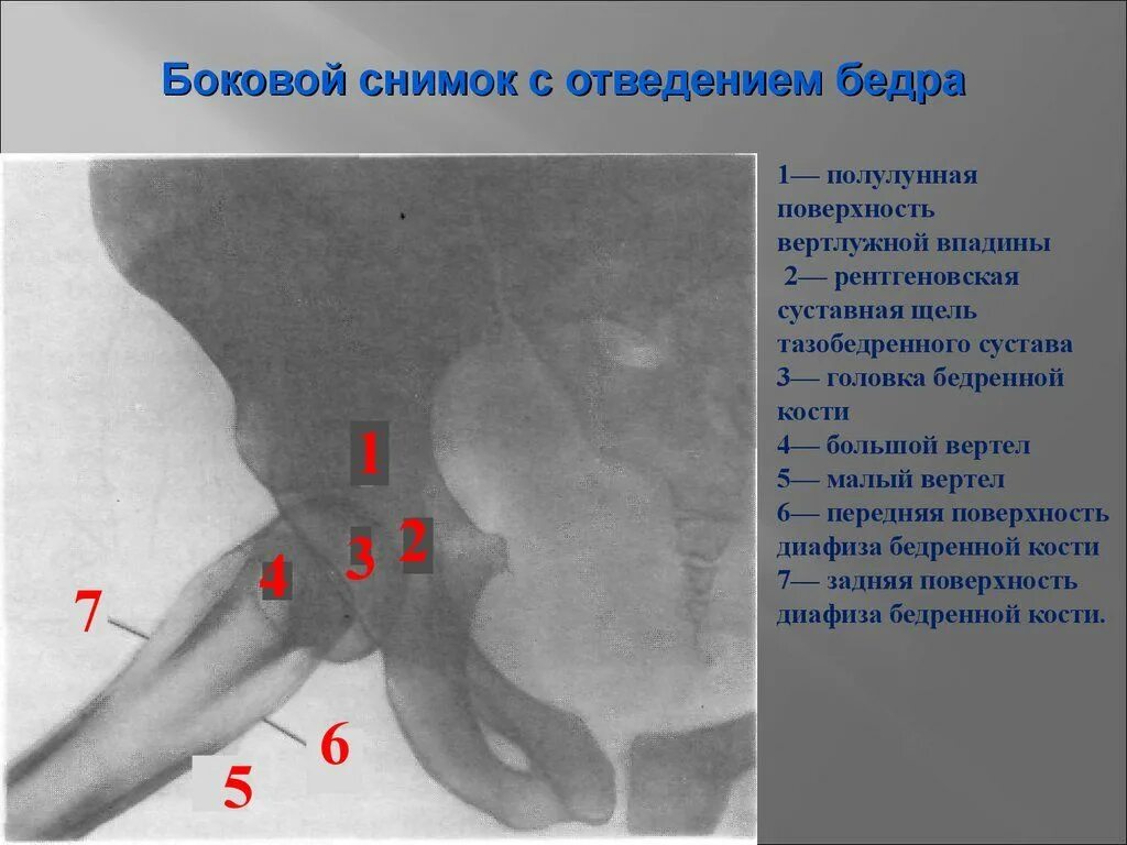 Склероз вертлужной впадины