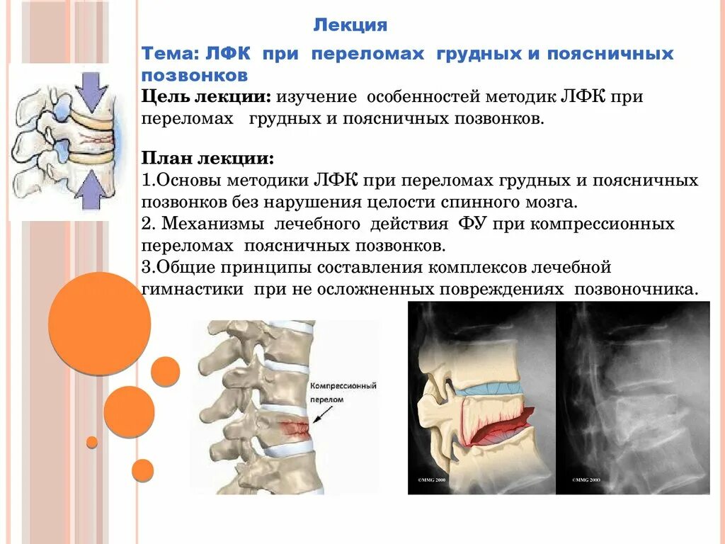 Почему нельзя сидеть при компрессионном переломе. Компрессионный перелом позвоночника т11. Компрессионный перелом позвоночника поясничного отдела позвонки. Перелом поясничных позвонков. ЛФК компрессионный перелом позвоночника.