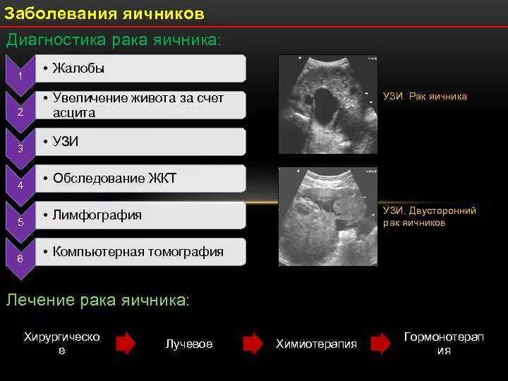 Злокачественная опухоль яичника. Объемные образования яичников. Опухоль яичников симптомы. Опухоль яичника симптомы. Рак яичников какие анализы