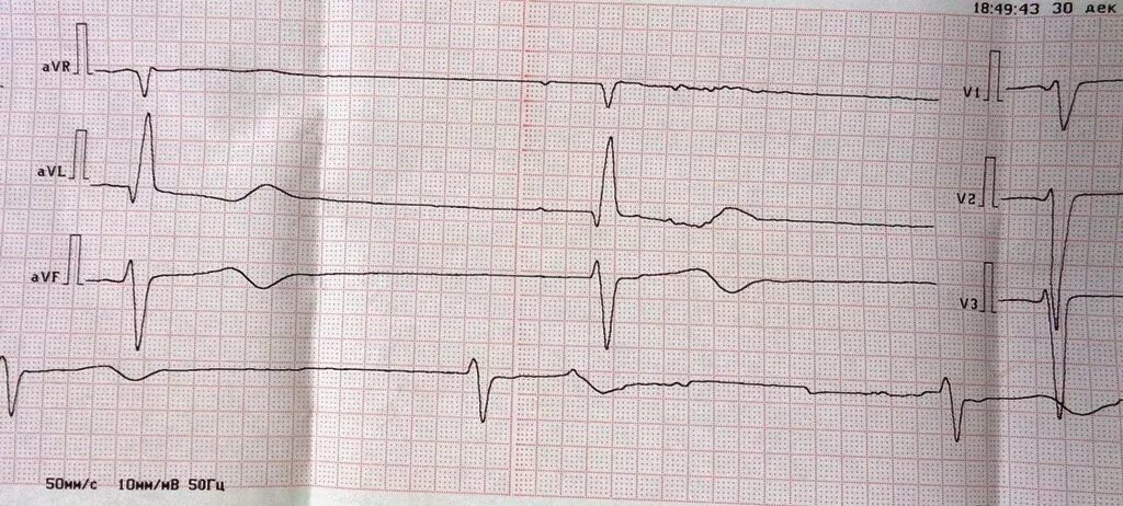 Брадикардия у ребенка 10. Синусовая брадиаритмия на экг. экг при брадиаритмии. экг при синусовой брадиаритмии. брадиаритмия на экг у ребенка.