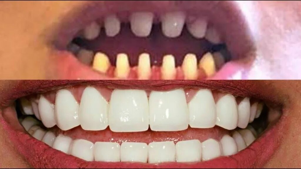 Спиливают ли зубы