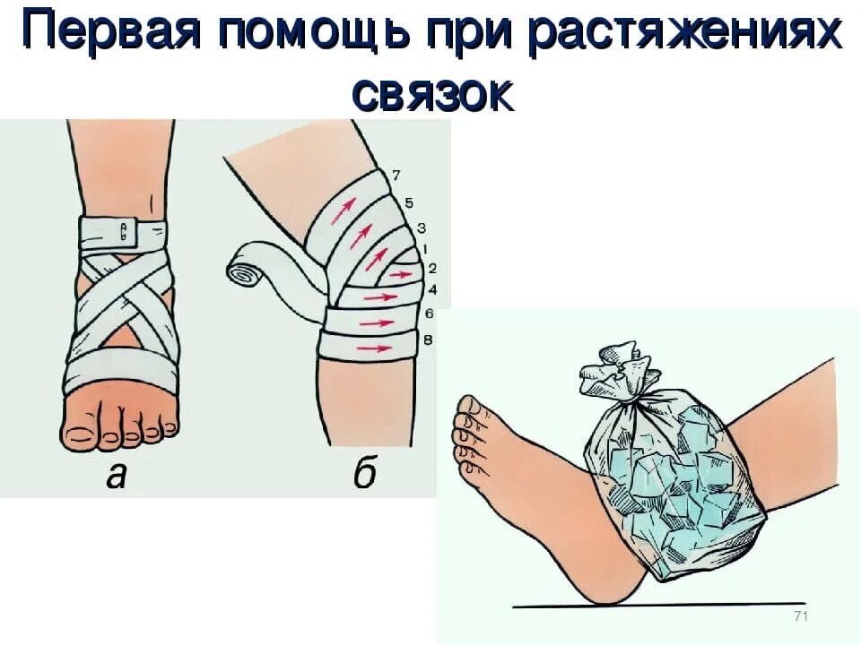 Алгоритм оказания первой медицинской помощи при растяжении связок. Алгоритм действий при растяжении. Первая помощд при растяженри чвязлк. Первая промошь при растяжение связок. Разрыв связок первая медицинская помощь