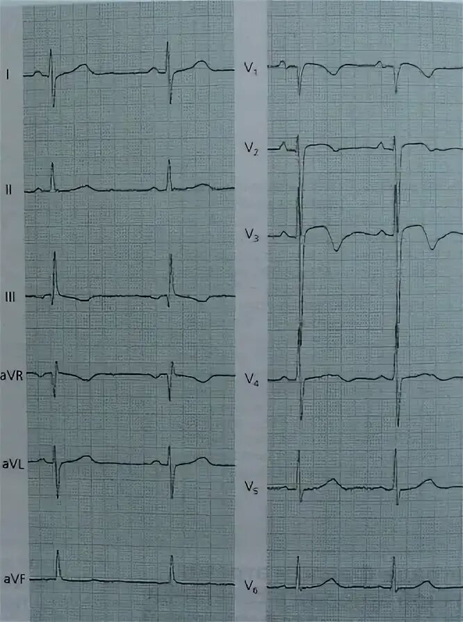 Ишемический подъем st. Подъем st v1 на экг. элевация st в v1-v3. подъем st в v2 v3. подъем сегмента ст в v1-v3.