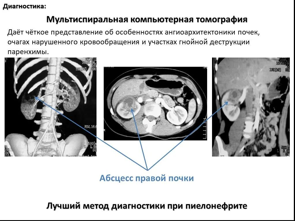 Пиелонефрит кт