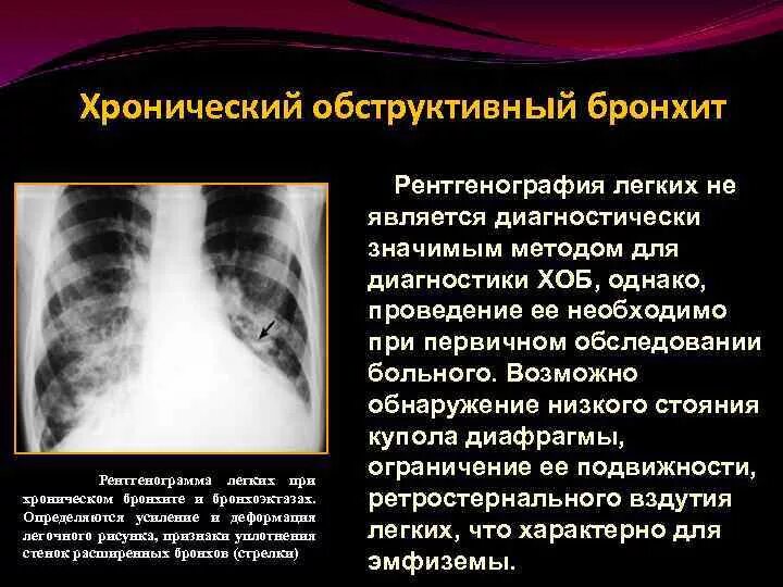 Описание бронхита. Хронический обструктивный бронхит рентген. Обструктивный бронхит рентген. Рентген при остром обструктивном бронхите. Рентген критерии хронического бронхита.