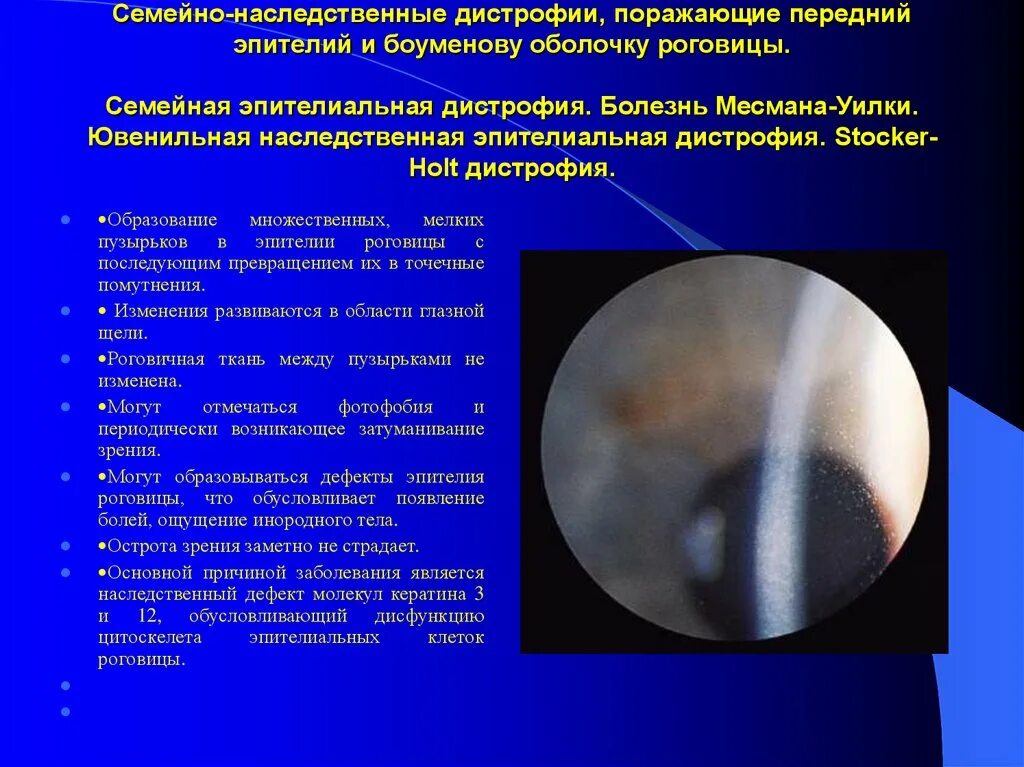 Дистрофия базальной мембраны эпителия роговицы. Дистрофия базальной мембраны эпителия. Решетчатая дистрофия роговицы. Стромальная дистрофия роговицы. Эндотелиально эпителиальная дистрофия.